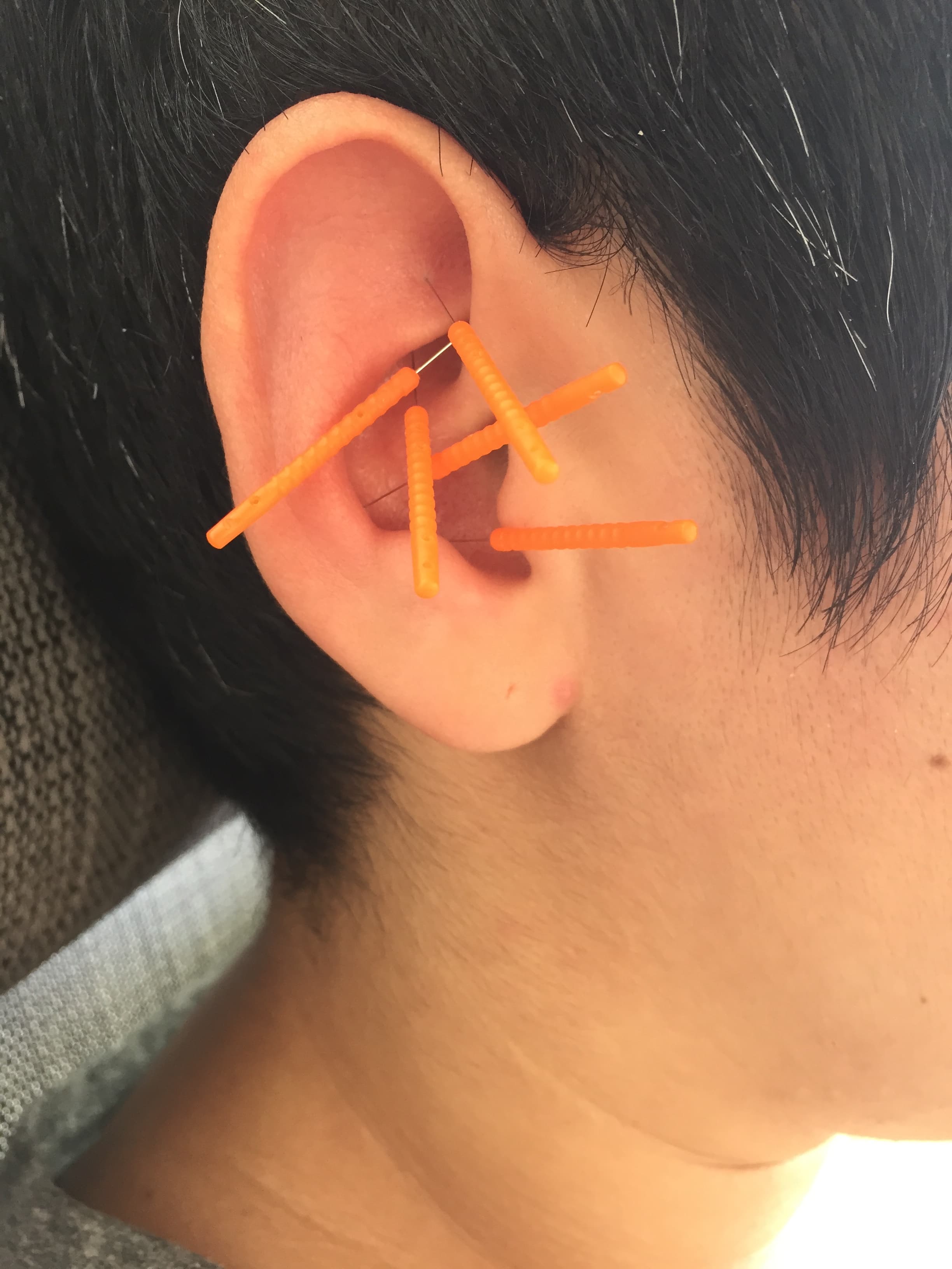 Pelvic floor acupuncture treatment at Pulse Community Care