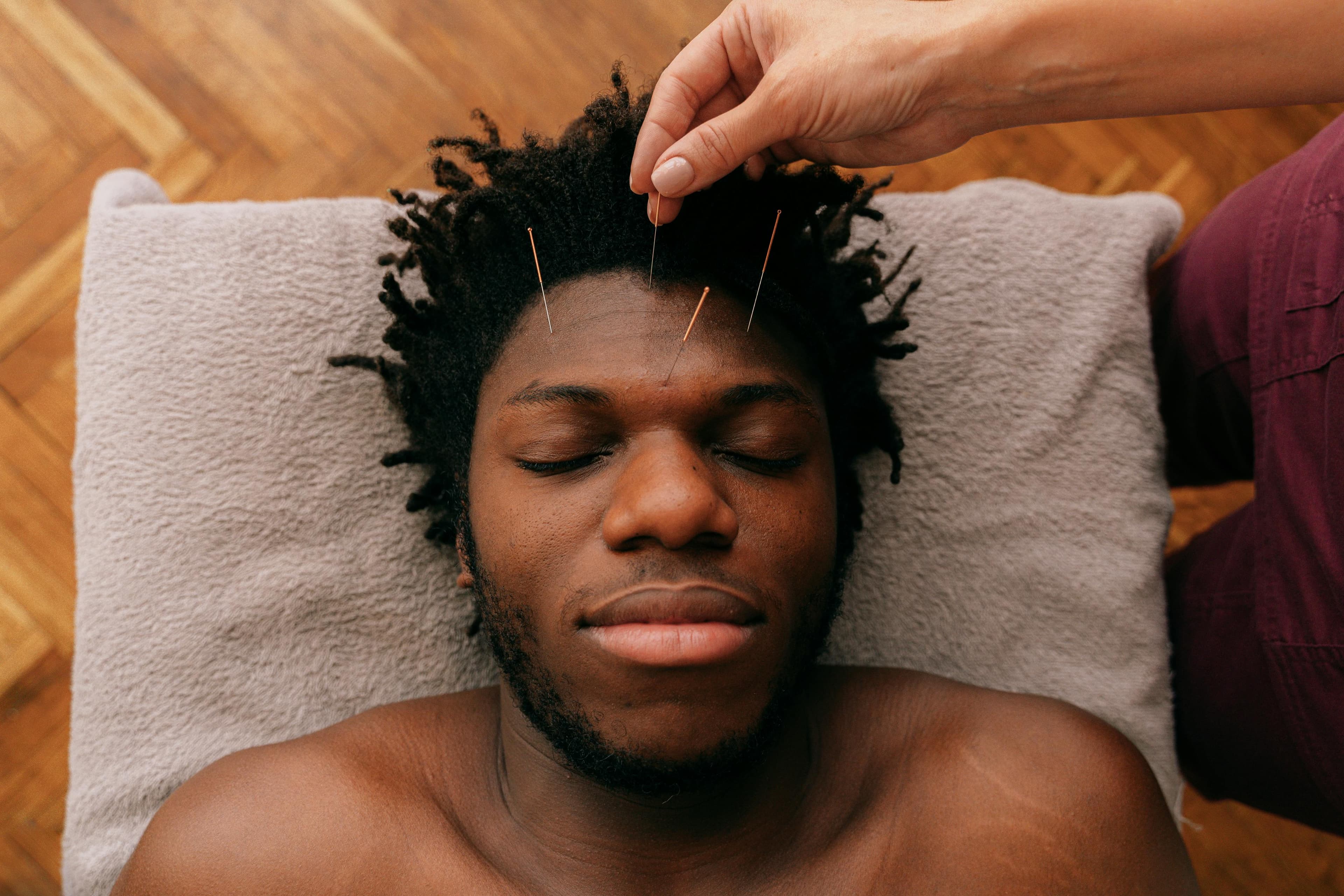 Patient resting peacefully with acupuncture needles during a treatment for anxiety and stress relief